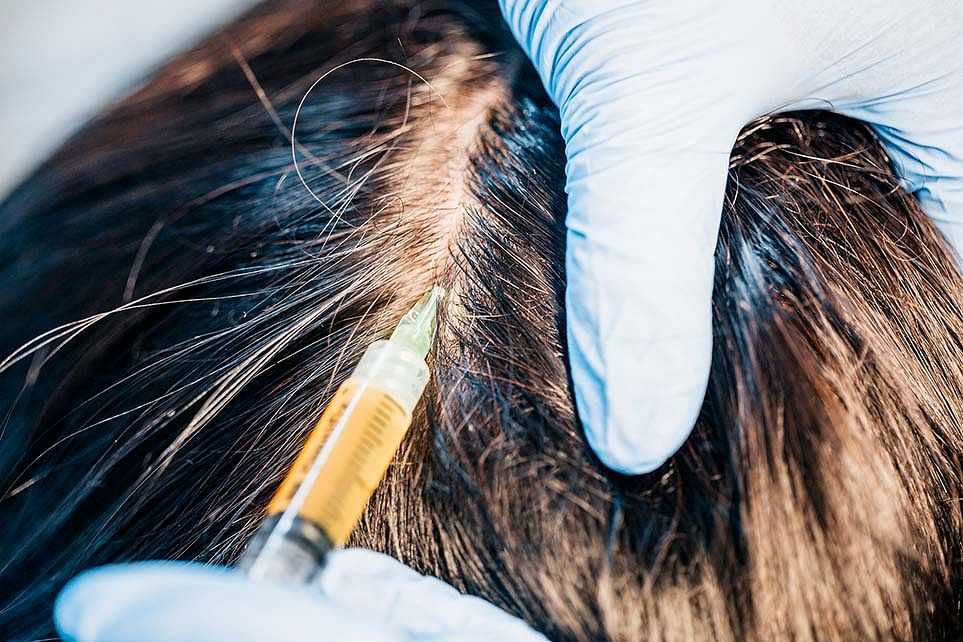 A gloved hand administers an injection to a person's scalp to promote hair growth.